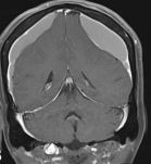 Fyraftensmøde: SIH – Spontan Intrakraniel Hypotension